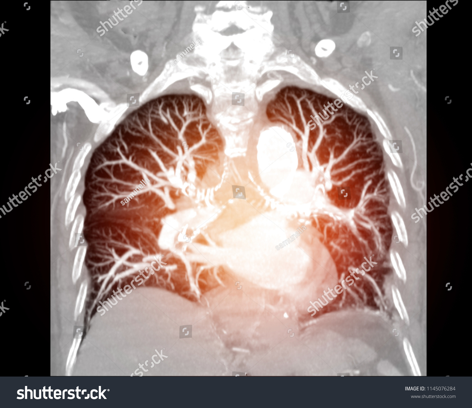 Cta Chest Ctpa Contrast Media Coronal Stock Photo 1145076284 | Shutterstock