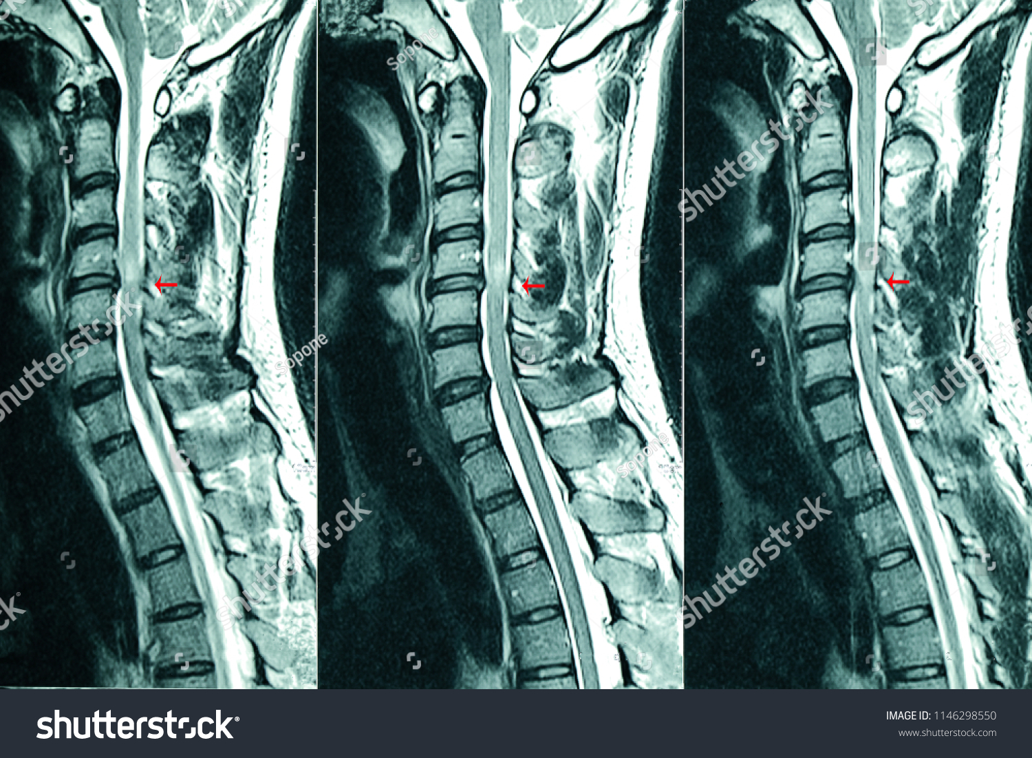 C Spines Mri Scan Patient Chronic Stock Photo 1146298550 Shutterstock