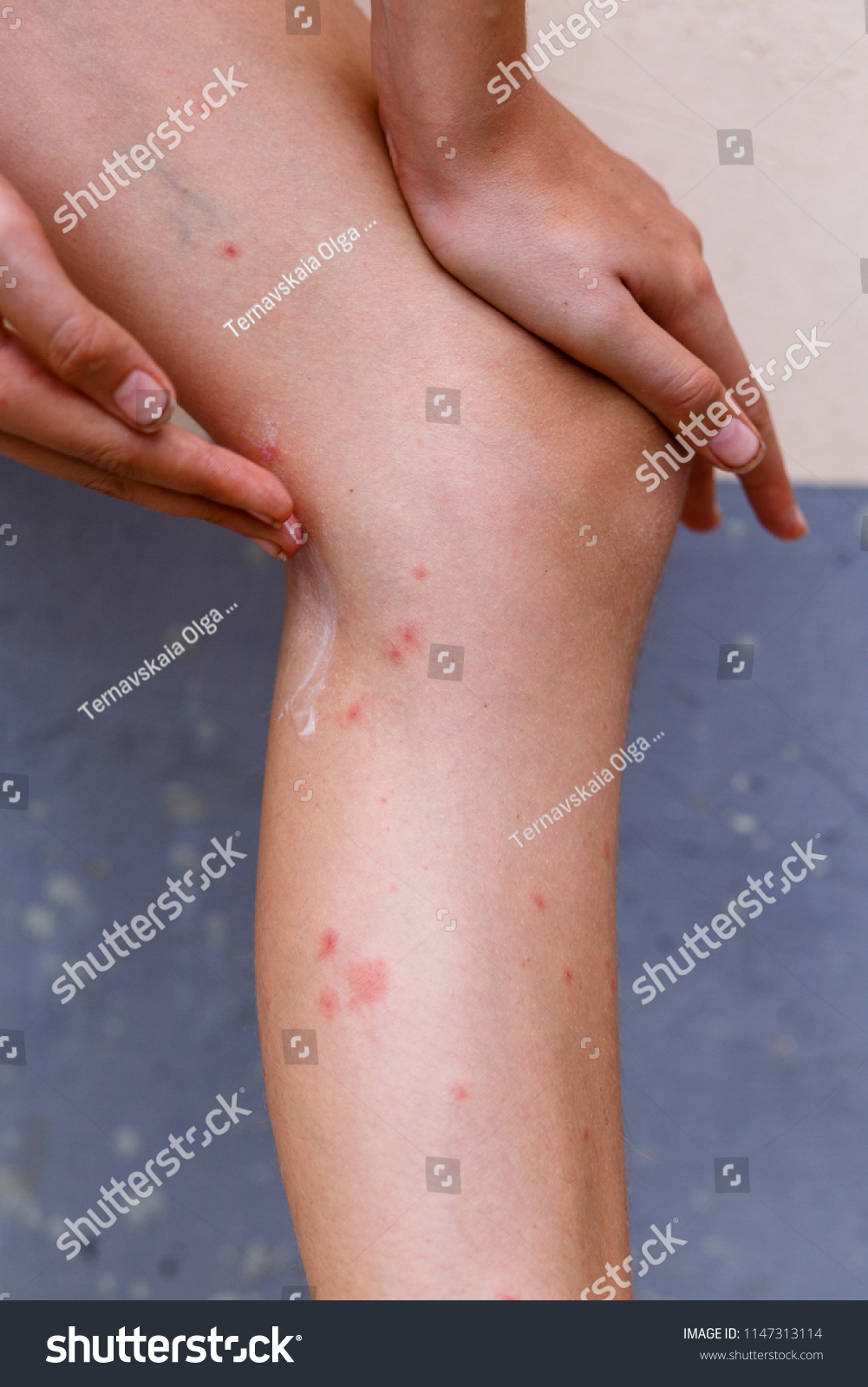 red itchy bumps on forearm