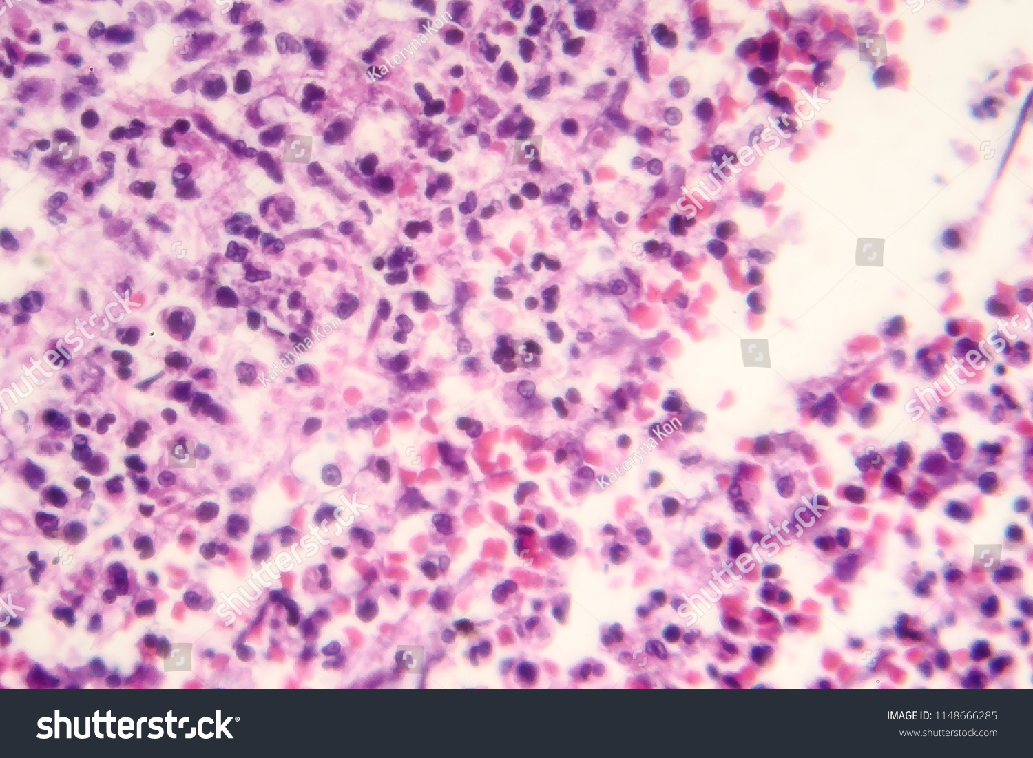 Inflammation Light Micrograph Showing Different Inflammatory Stock ...