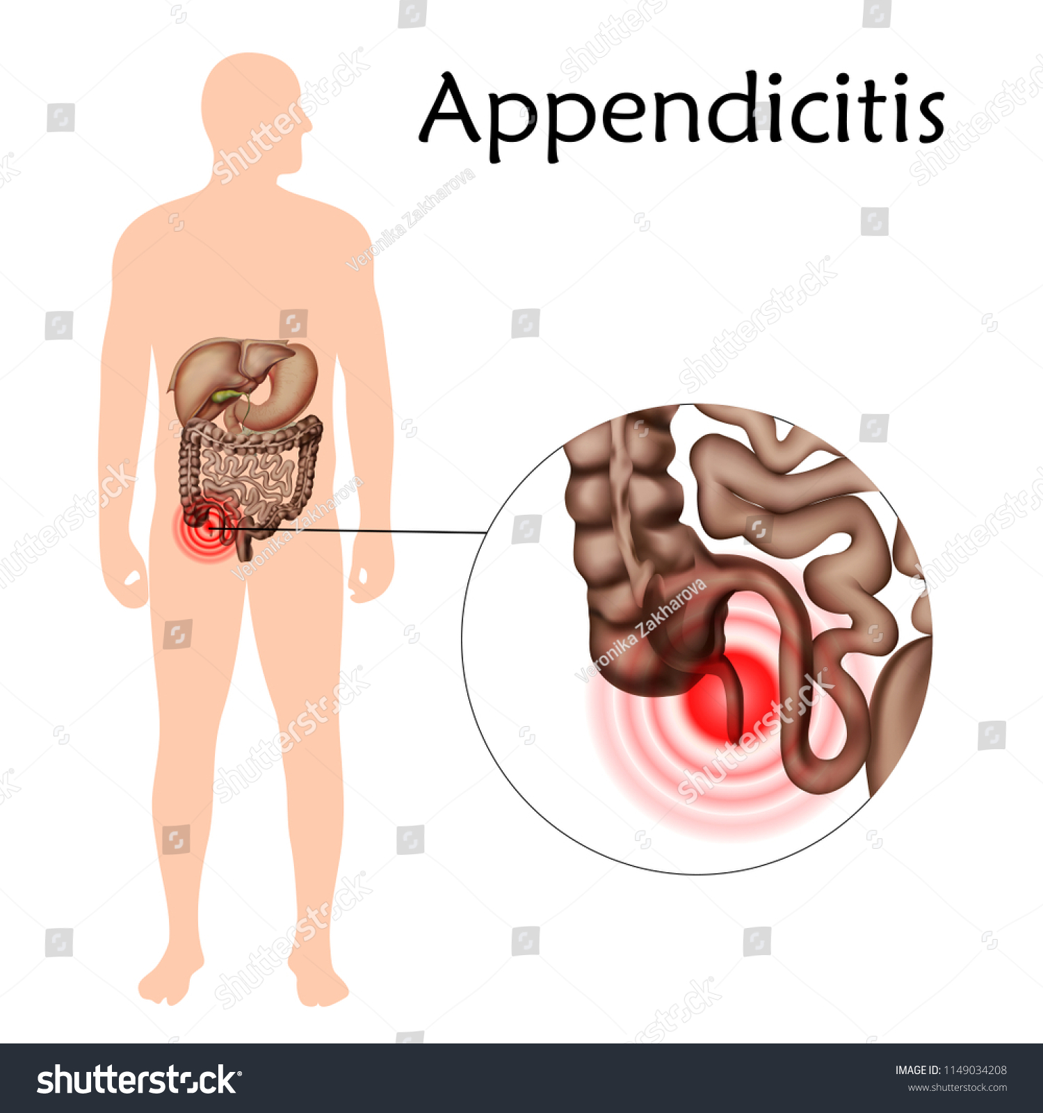 Stock Vektor „inflammation Appendix Appendicitis Anatomy Vector