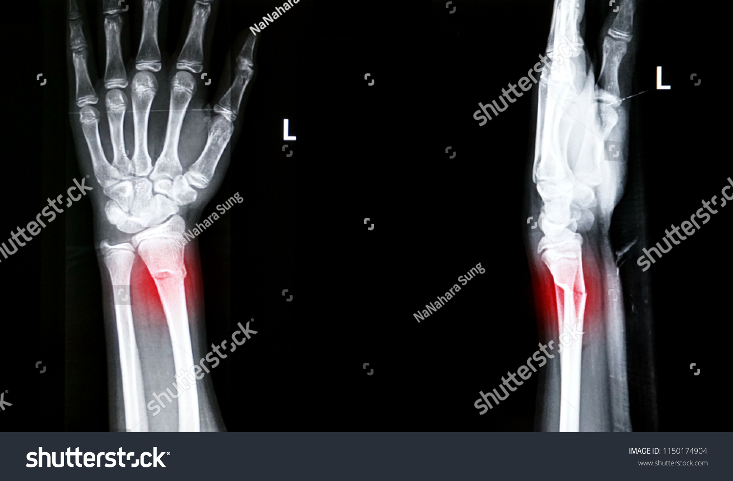 Film Xray Left Wrist Join Show Stock Photo 1150174904 | Shutterstock