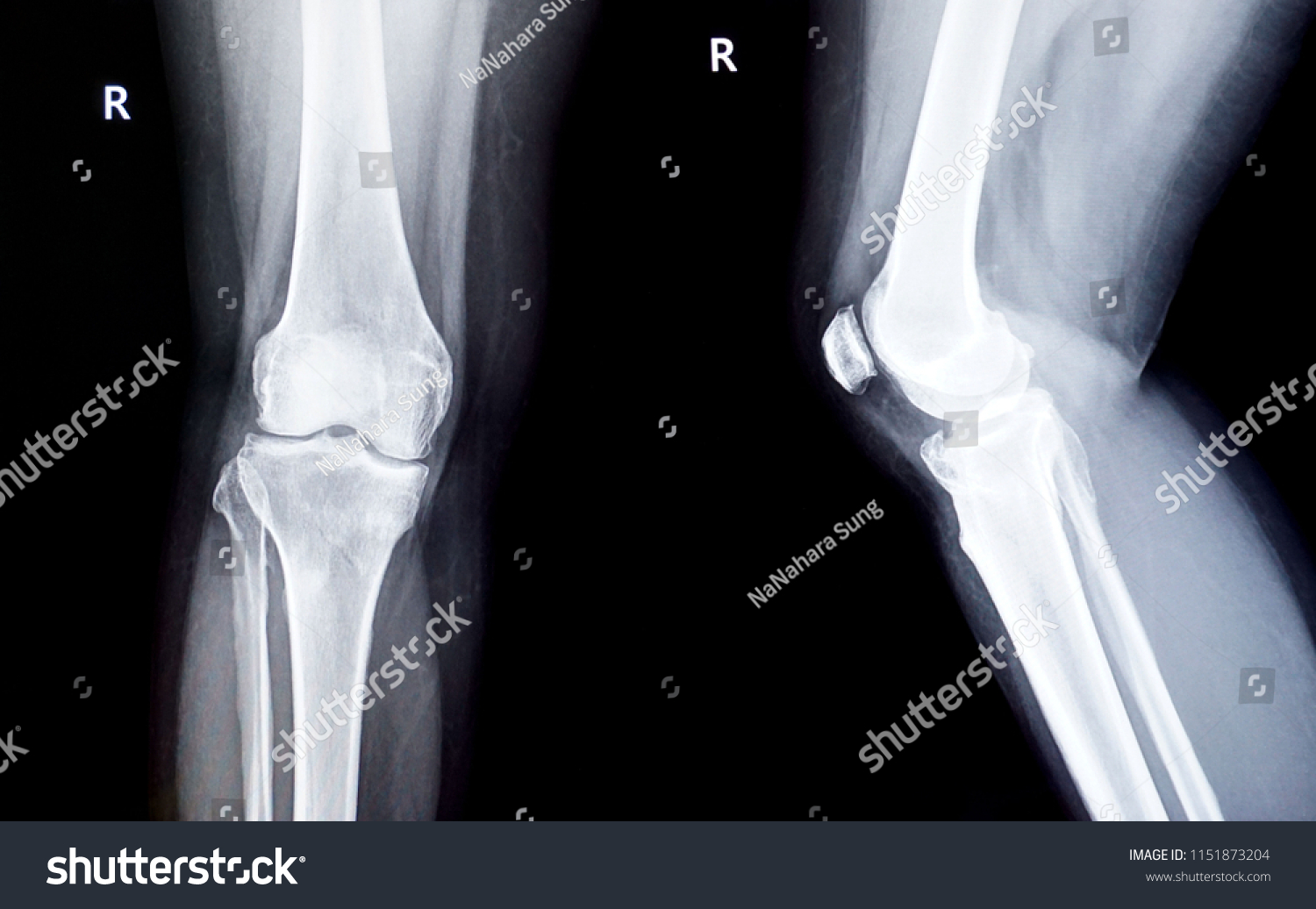 Film Xray Right Knee Stock Photo 1151873204 | Shutterstock