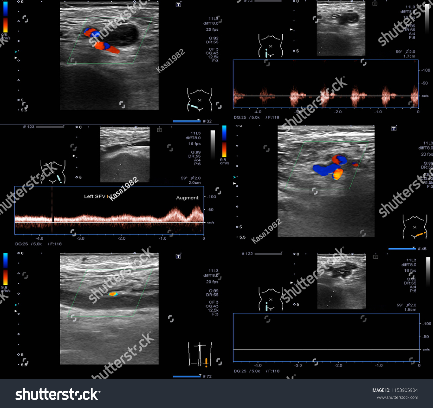 Ultrasound Color Doppler Acute Dvt Right Stock Photo 1153905904 ...