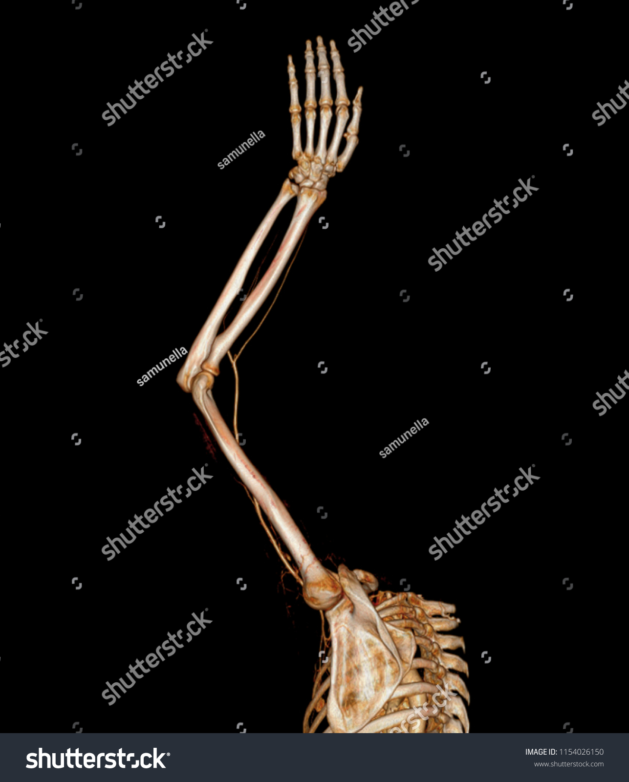 Cta Brachial Artery Ct Scan Upper Stock Illustration 1154026150