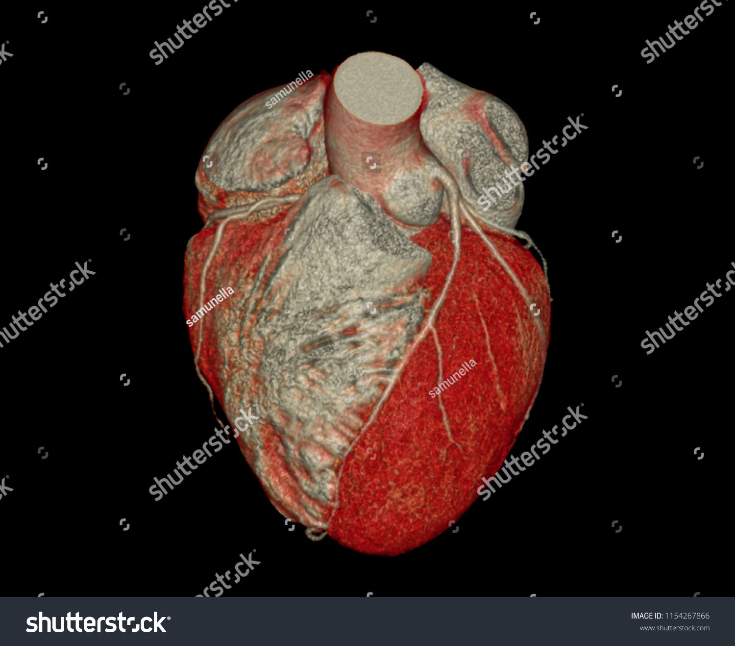 Top View Cta Coronary Artery 3d Stock Illustration 1154267866 ...