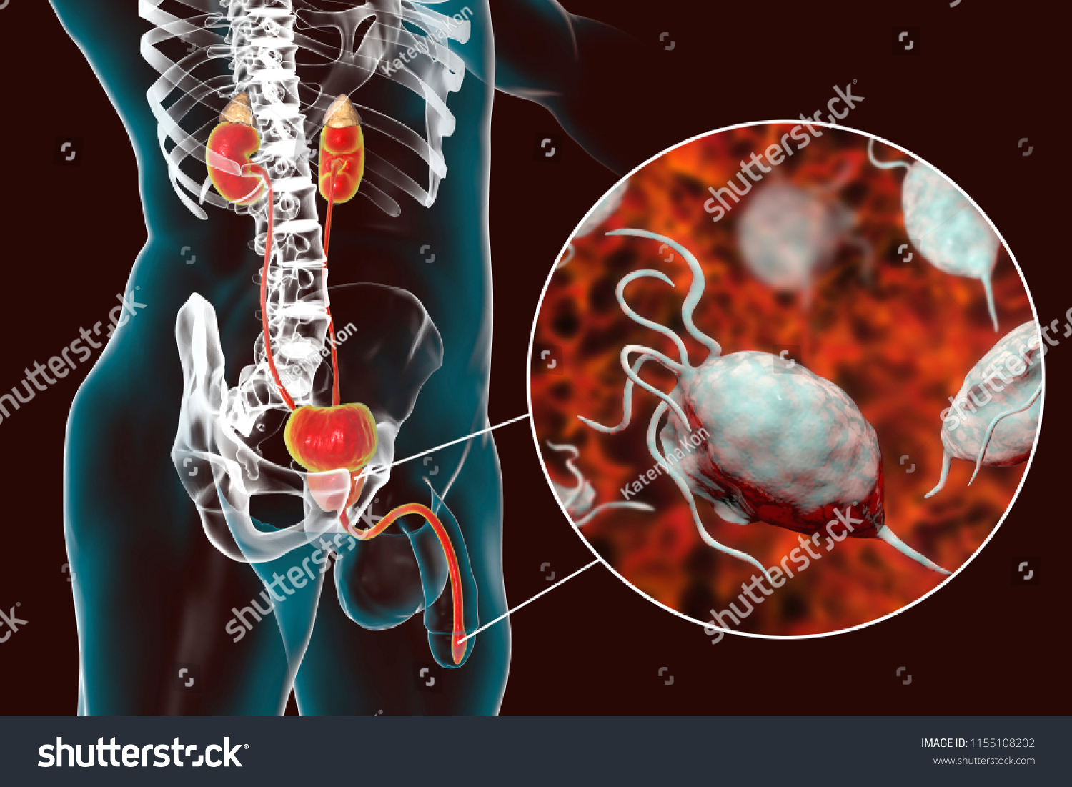 Trichomoniasis Infection Man D Illustration Showing Stock Illustration Shutterstock