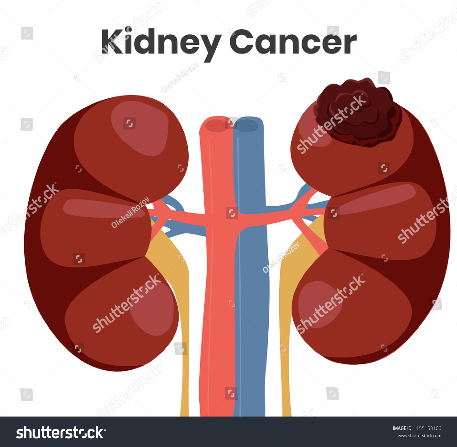 Vector Illustration Kidney Cancer Tumor Affecting Stock Vector (Royalty ...