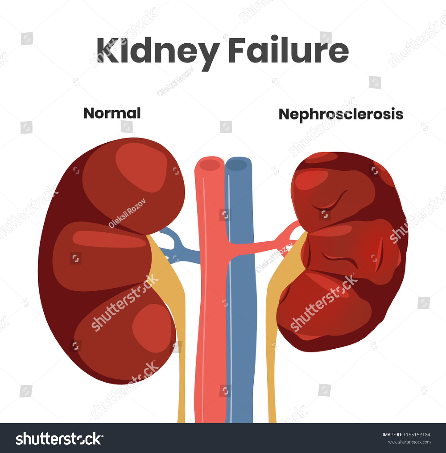 Vector Illustration Kidney Failure Normal Kidney Stock Vector (royalty 