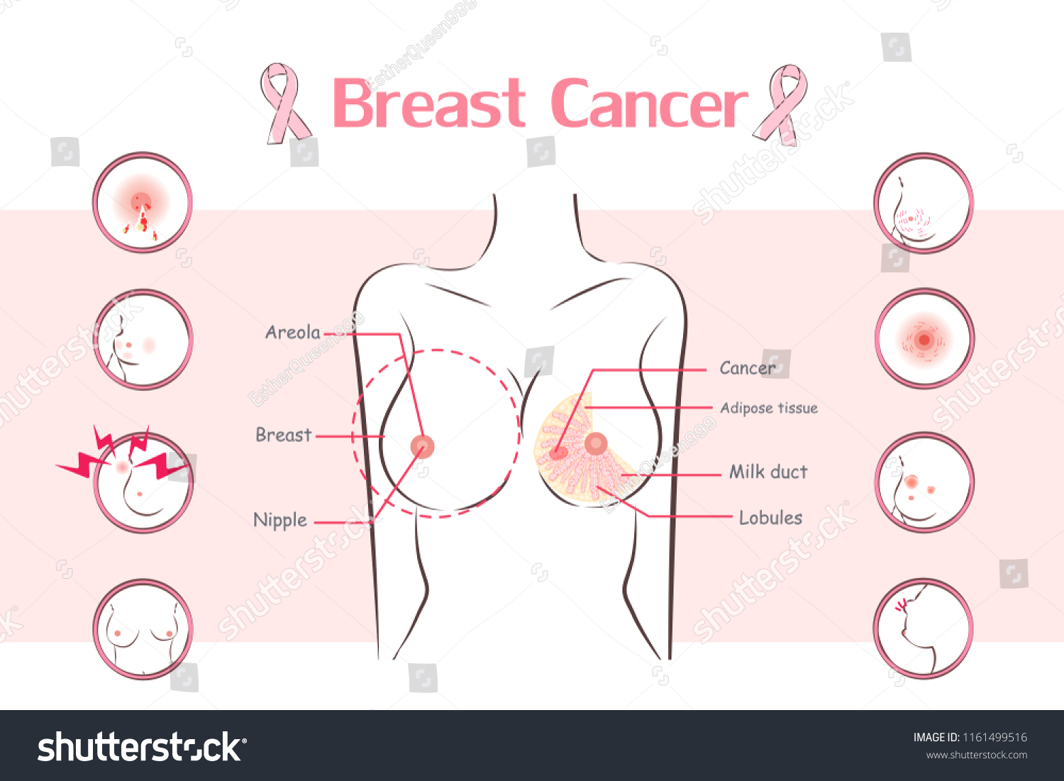 симптому рака груди у женщин фото 86