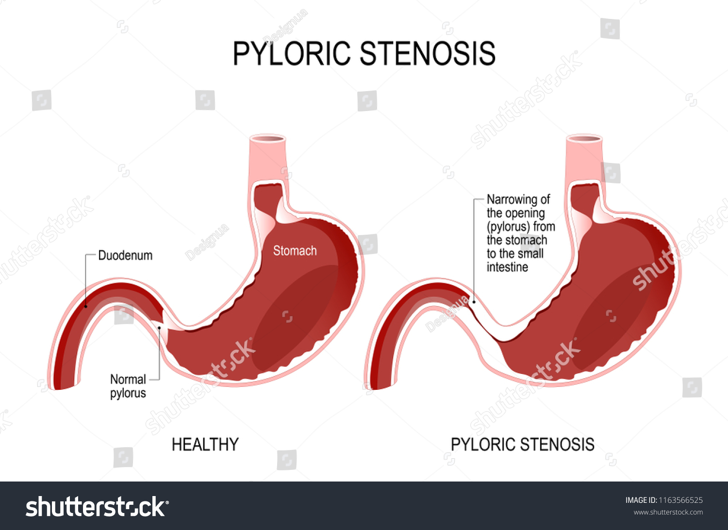 Pyloric Stenosis Narrowing Opening Pylorus Stomach Stock Vector ...