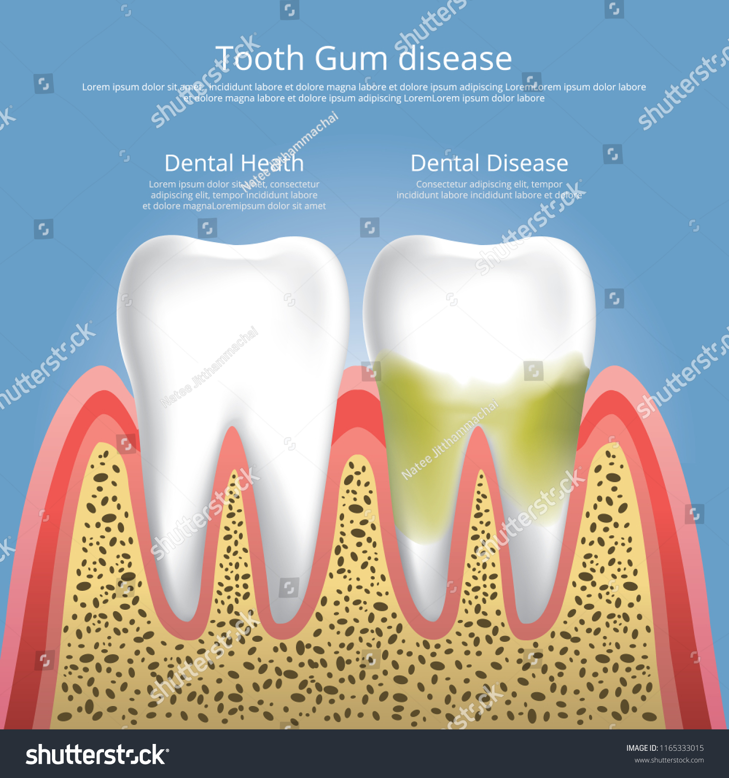 Human Teeth Stages Gum Disease Vector Stock Vector (Royalty Free ...