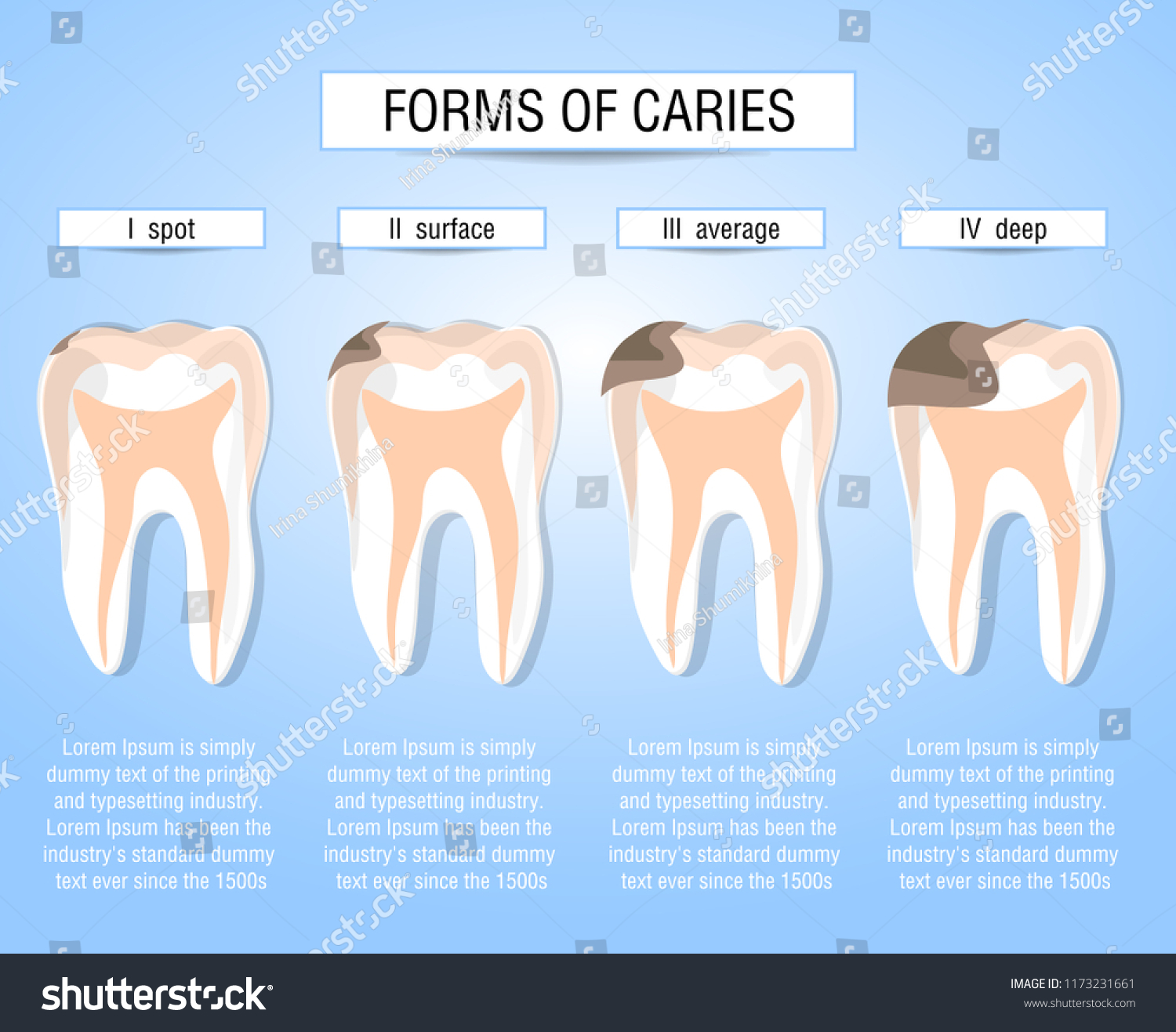 dental caries process