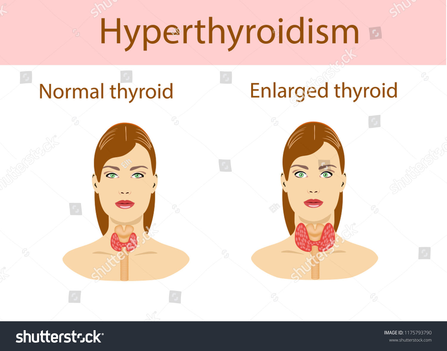 Woman Enlarged Hyperthyroid Gland Vector Illustration Stock Vector ...