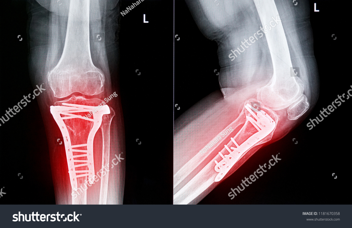 Xray Image Show Fracture Knee Stock Photo 1181670358 | Shutterstock