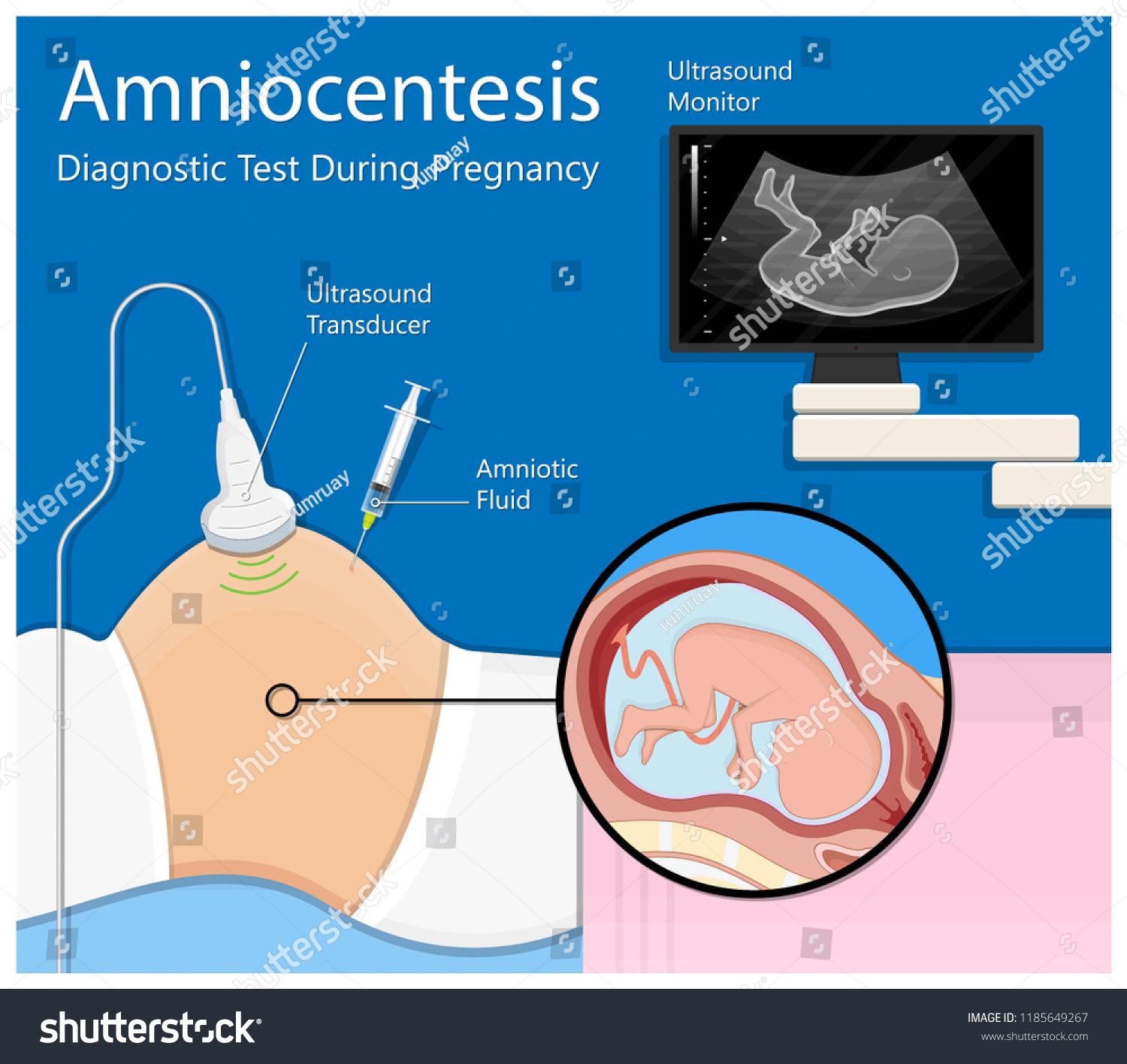 Amniocentesis Diagnostic Test Treat Lab Analysis Vector De Stock Libre De Regalías 1185649267 4359