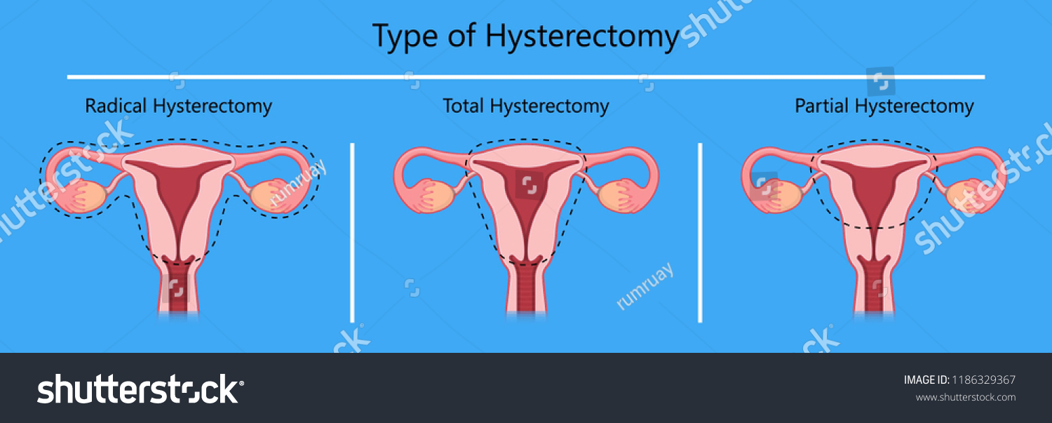 Laparoscopic Hysterectomy Medical Surgical Treat Cervix Stock Vector Royalty Free 1186329367 3206