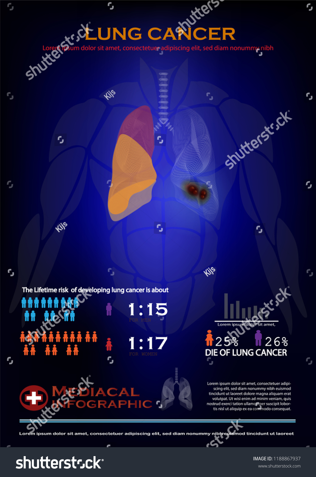 Lung Cancer Infographic Stock Vector Royalty Free 1188867937