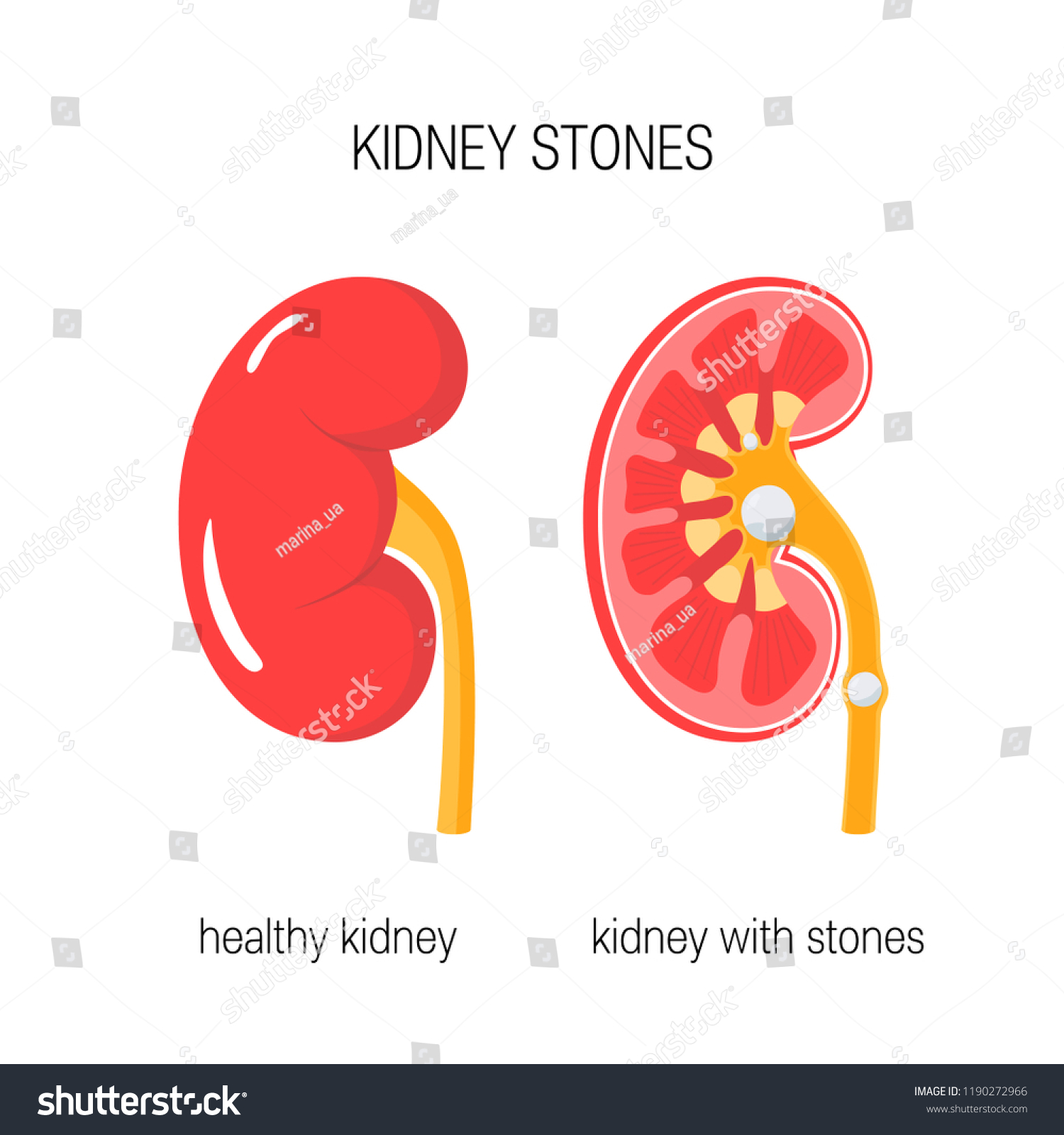 Kidney Stones Healthy One Kidney Disease Stock Vector (Royalty Free ...