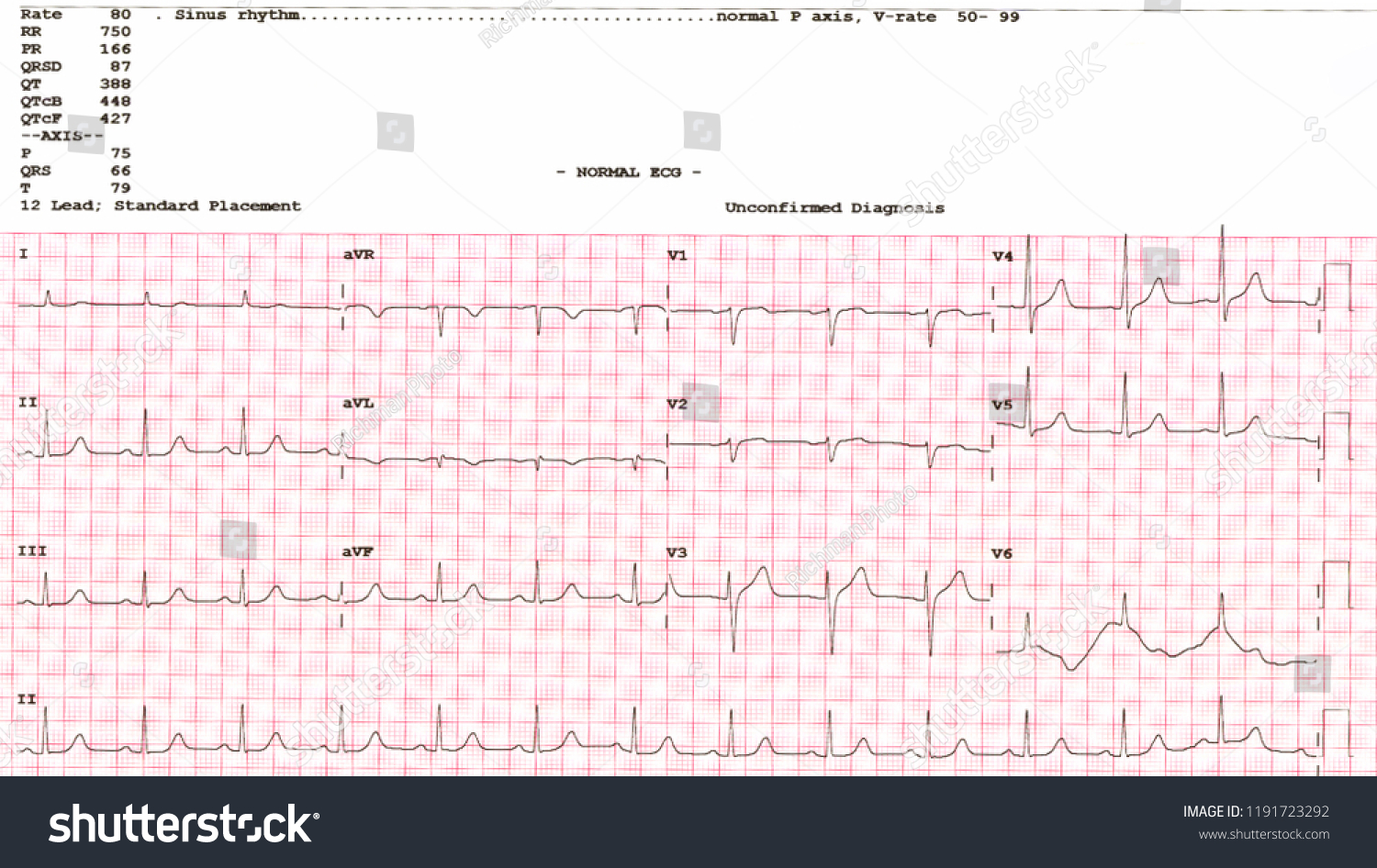 Cardiogram Waveform Ekg Showing Normal Ekg Stock Photo 1191723292 ...