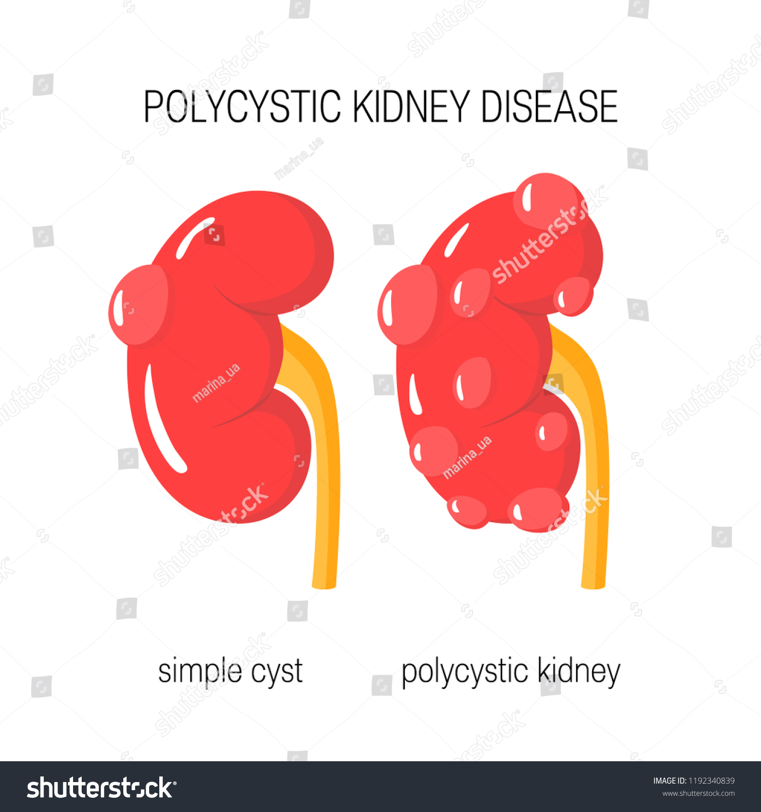 Polycystic Kidney Disease Concept Vector Illustration Stock Vector ...