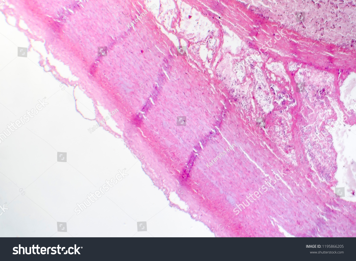 Fibrinoid Necrosis Vessel Wall Light Micrograph Stock Photo 1195866205 ...