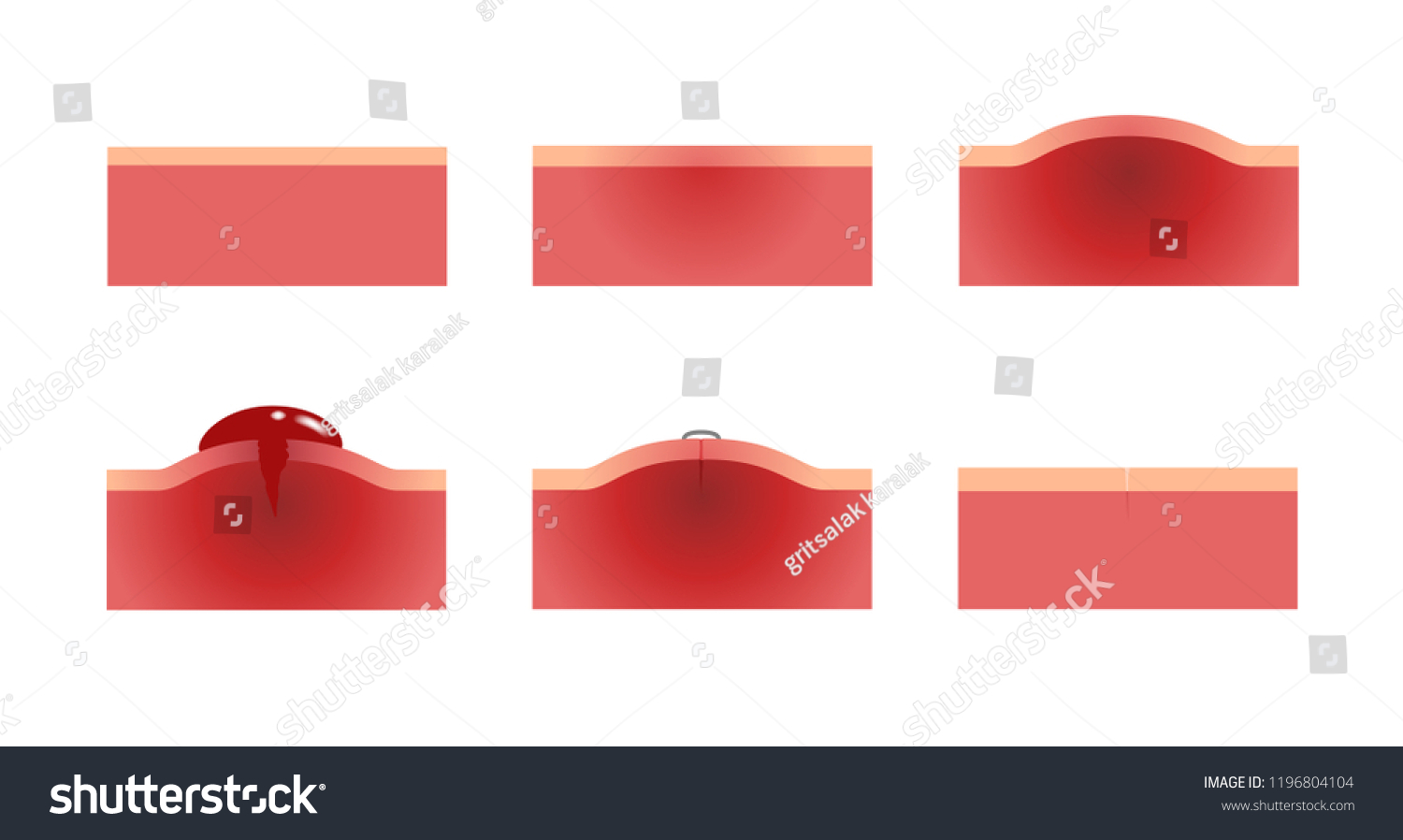 Wound Bleeding Skin Graphic Anatomy Vector Stock Vector (Royalty Free ...