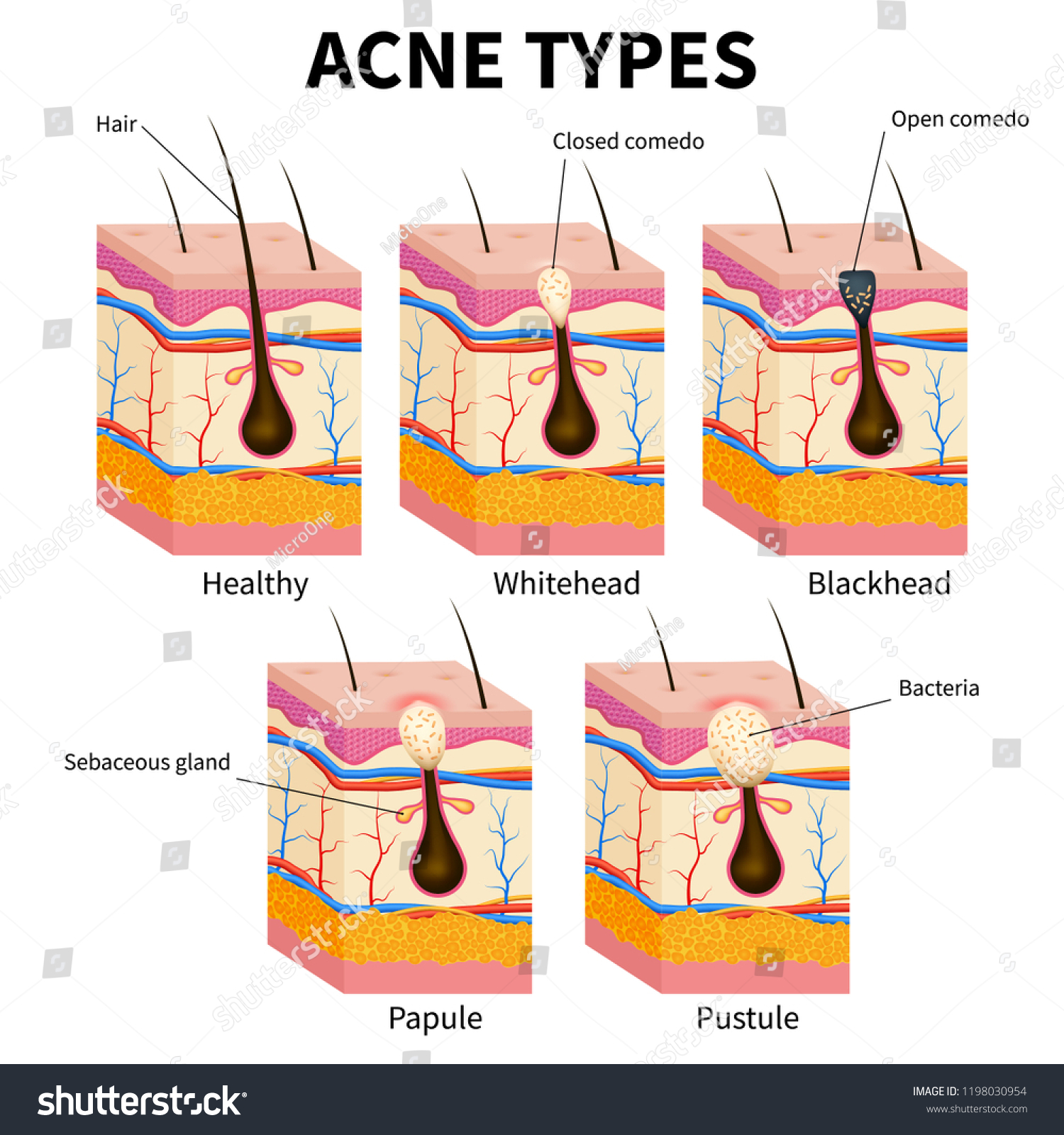 Acne Types Pimple Skin Diseases Anatomy Stock Vector Royalty Free Shutterstock