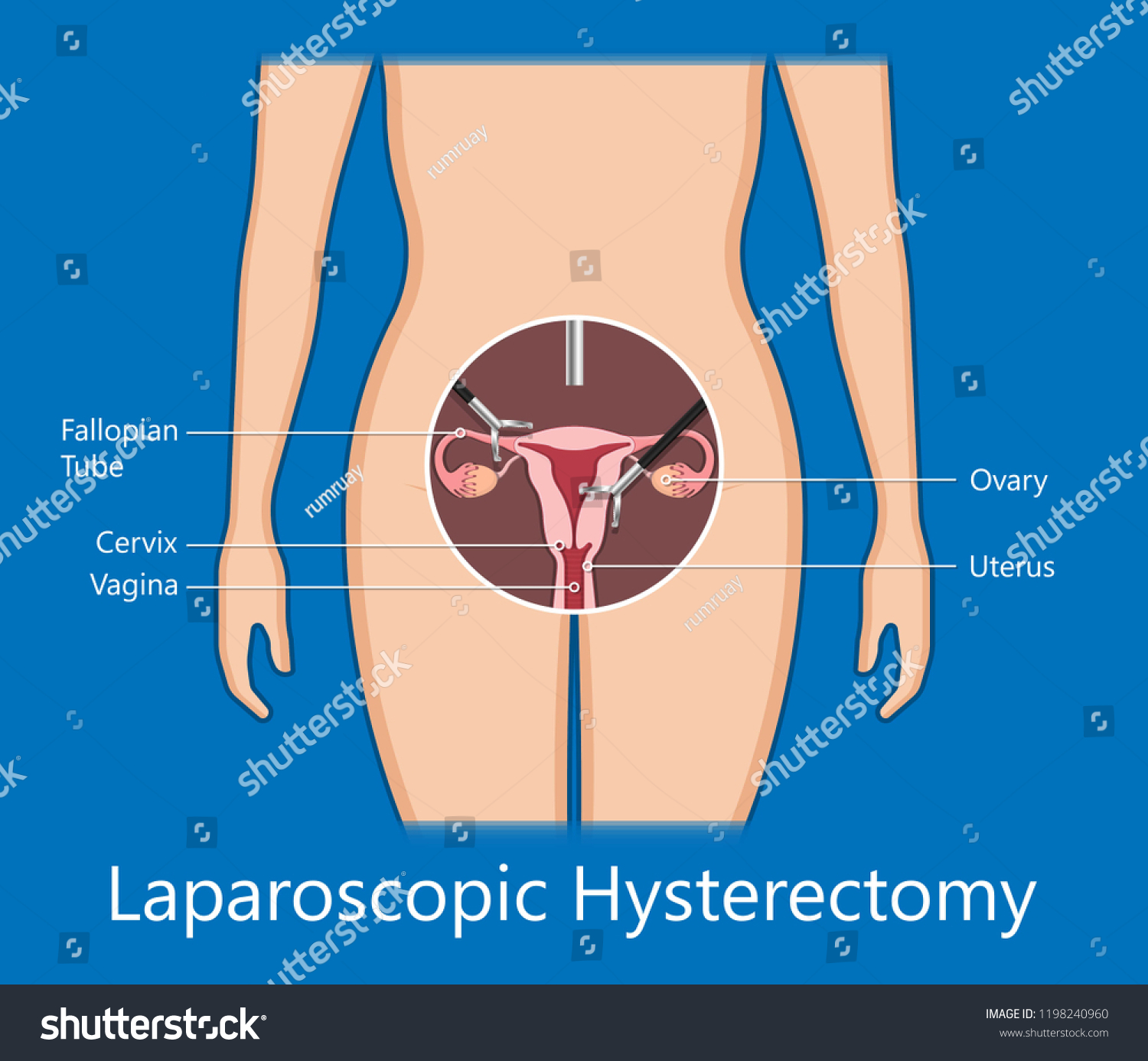 Laparoscopic Hysterectomy Medical Surgical Treat Cervix Stock Vector Royalty Free 1198240960 7345