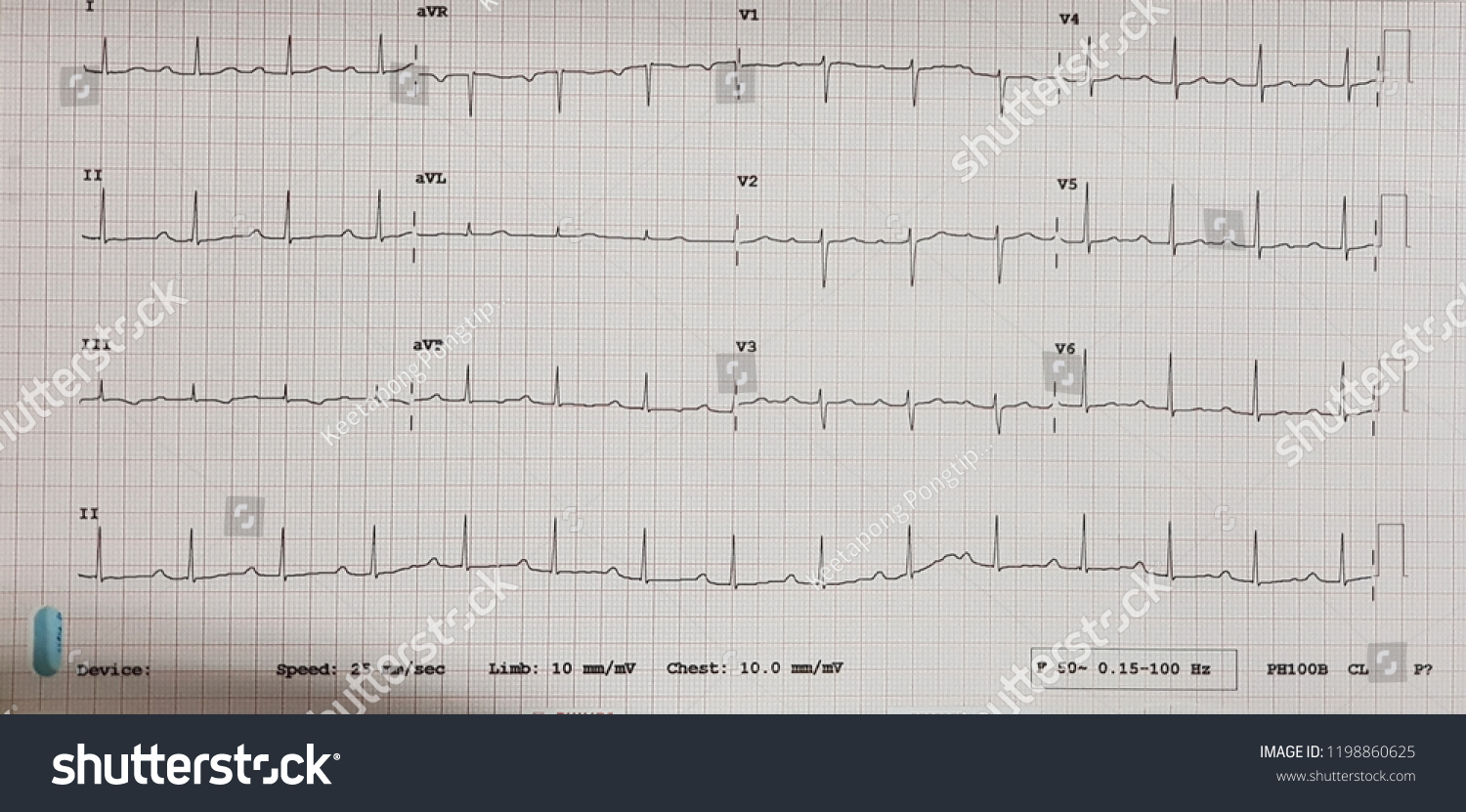 First Degree Av Block Normal Sinus Stock Photo 1198860625 | Shutterstock