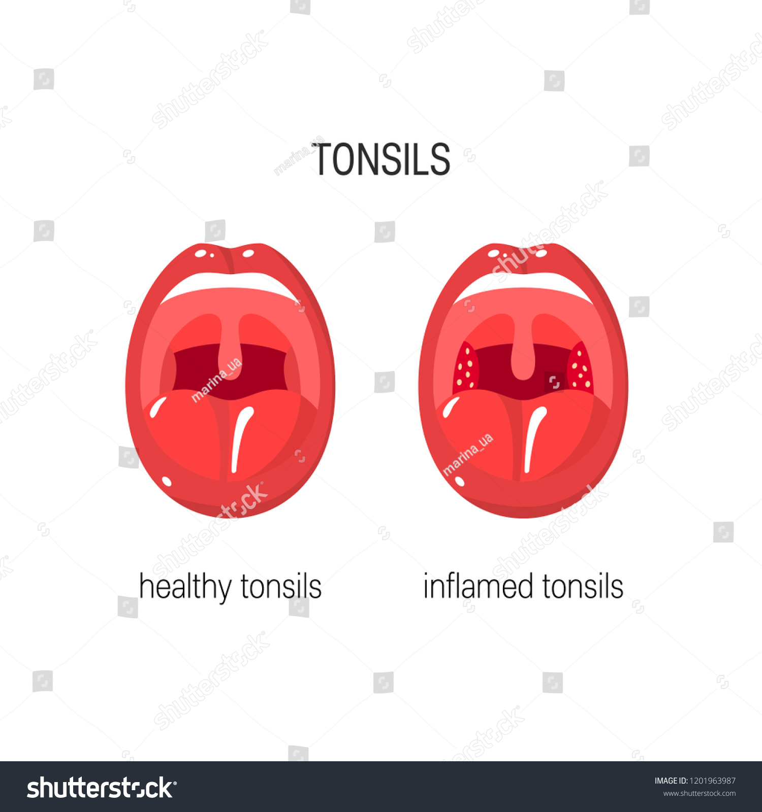 Healthy Infected Tonsils Vector Concept Simple Stock Vector (Royalty ...