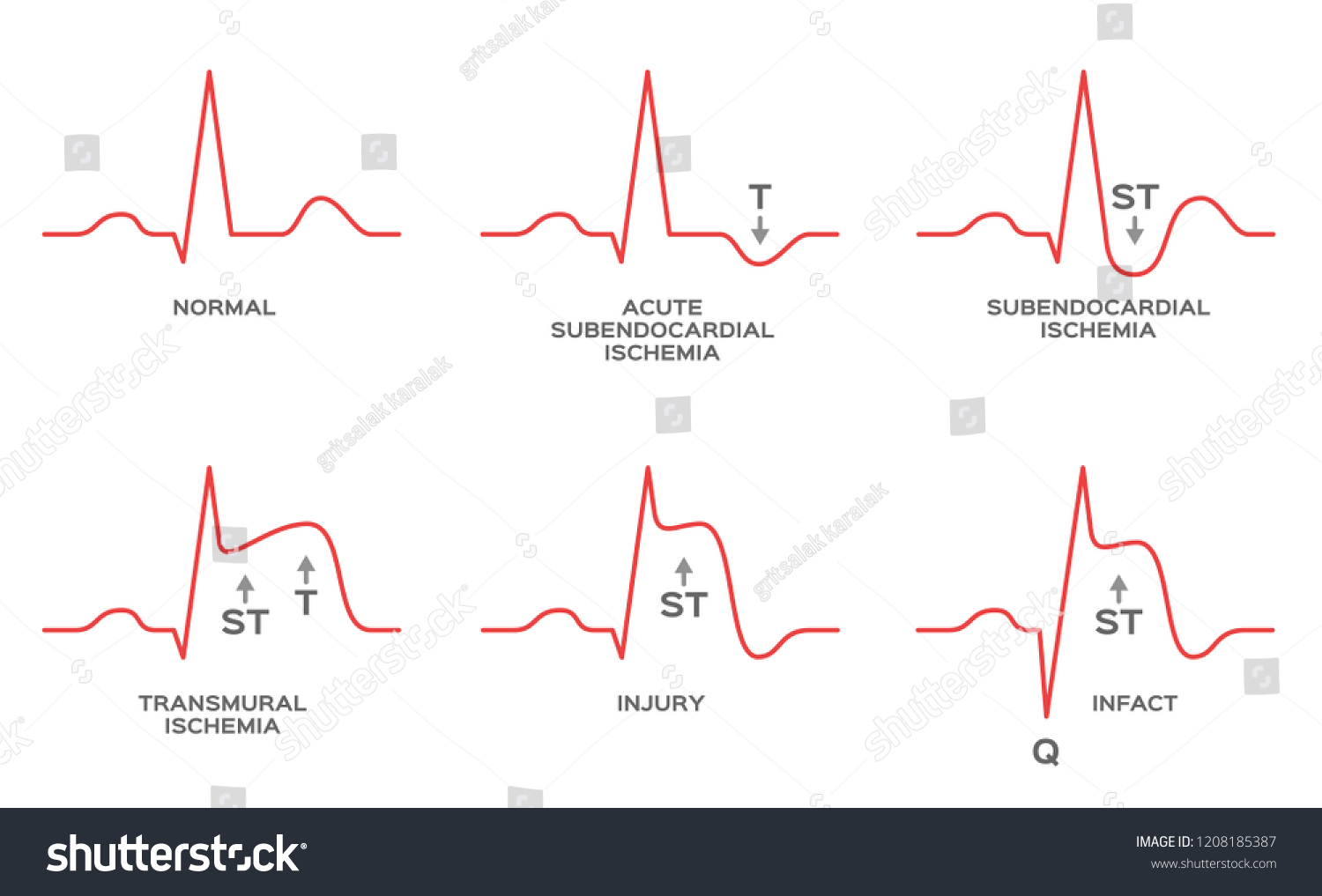 Nstemi Vs Stemi Cheat Sheet