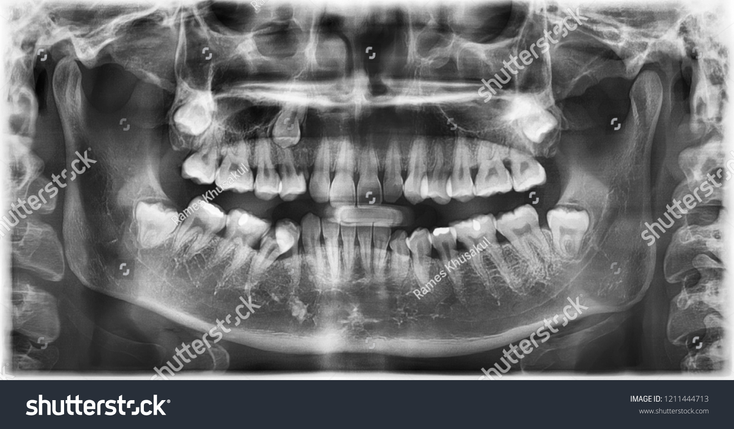 Panoramic Radiograph Show Right Left Maxillary Stock Photo 1211444713 ...