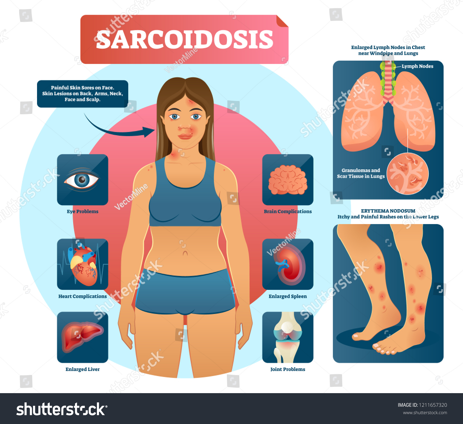 Sarcoidosis Vector Illustration Lungs Heart Eyes Stock Vector Royalty