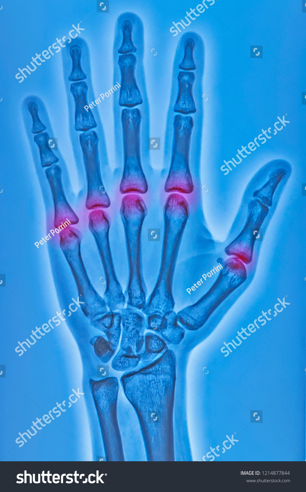 29 Metacarpophalangeal Joint Images, Stock Photos & Vectors | Shutterstock