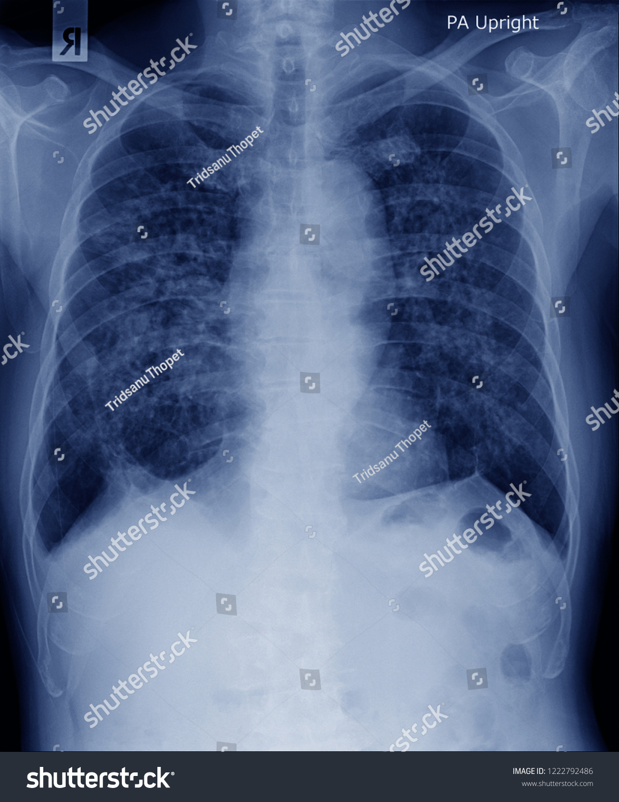 Chest Xray Image Secretion Inside Both Stock Photo 1222792486 ...