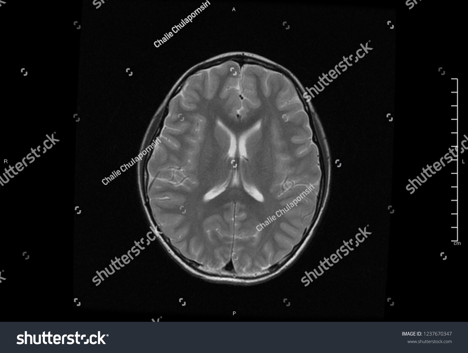 Magnetic Resonance Image Mri Brain Axial Stock Photo 1237670347 ...