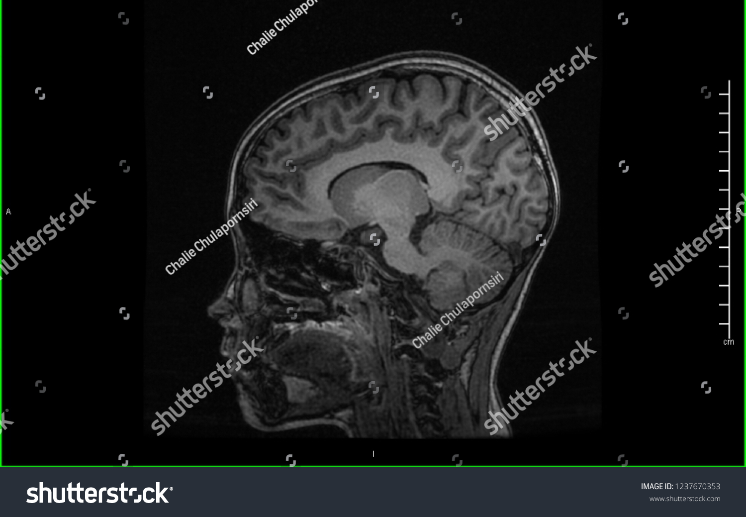 Magnetic Resonance Image Mri Brain Sagittal Stock Photo 1237670353 ...