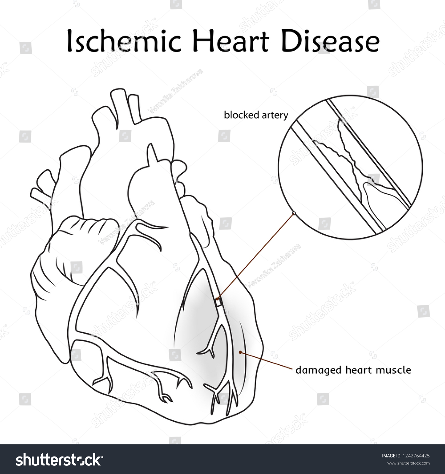 Ischemic Heart Disease Blocked Artery Damaged Stock Vector (Royalty ...