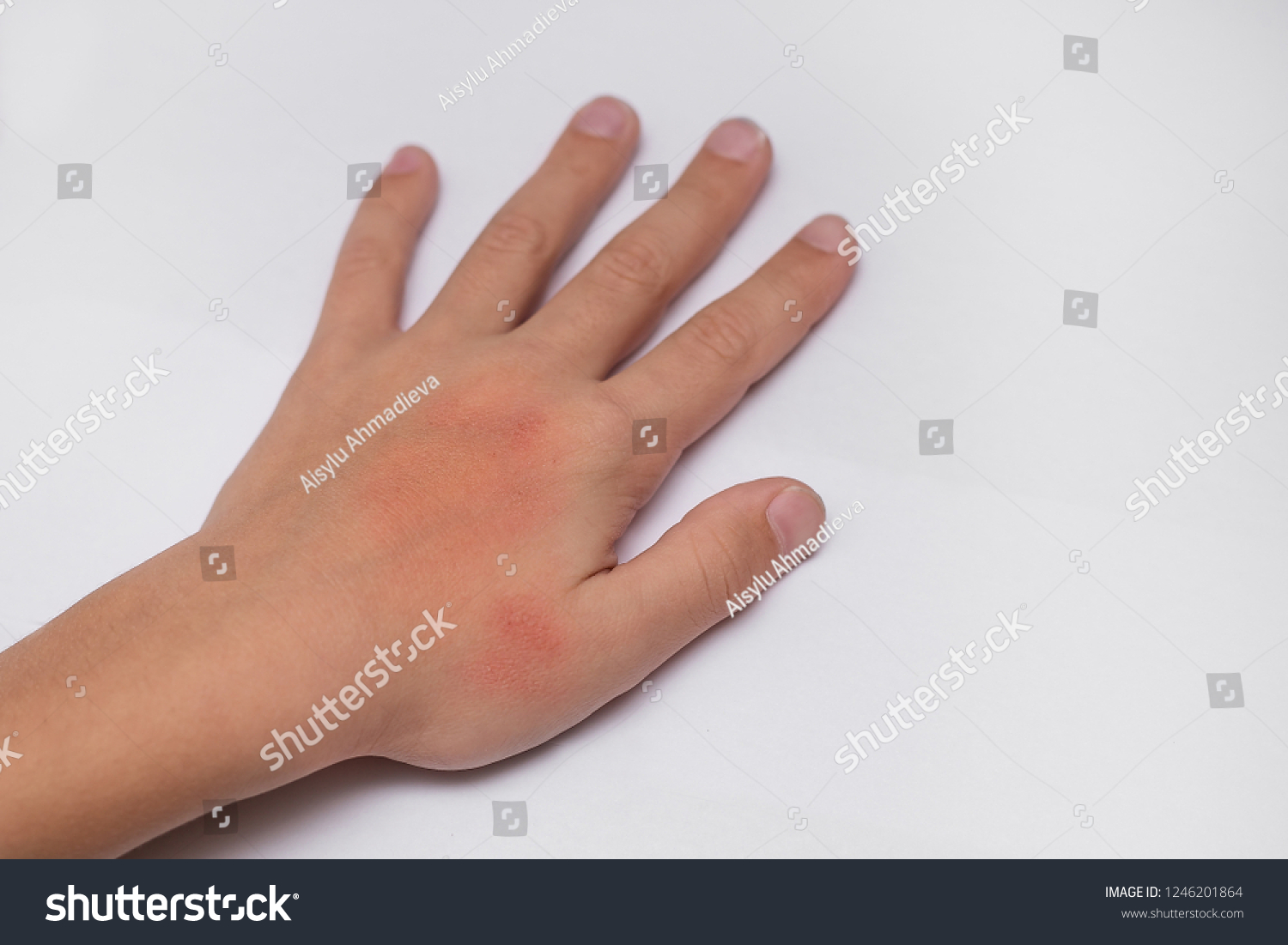 red-spots-on-child-hands-skin-stock-photo-1246201864-shutterstock