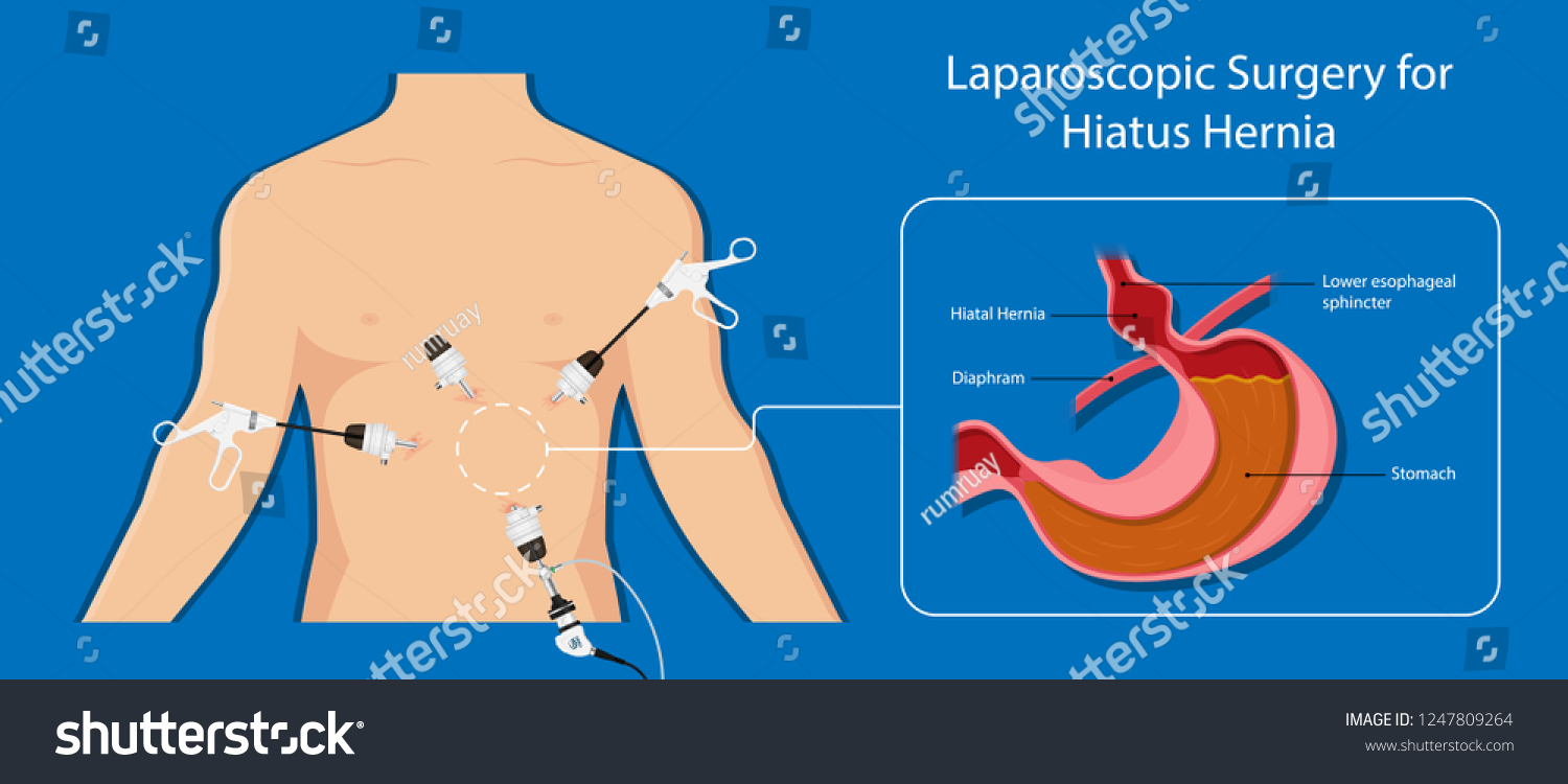Gastroesophageal Reflux Disease Gerd Hiatal Hernia Stock Vector