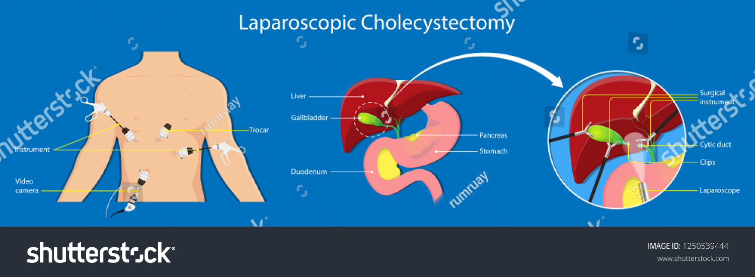 Желчный после операции. Лапаротомия при холецистите. Infundibular technique of Laparoscopic Cholecystectomy. Различия между Cholecystectomy и Laparoscopy.