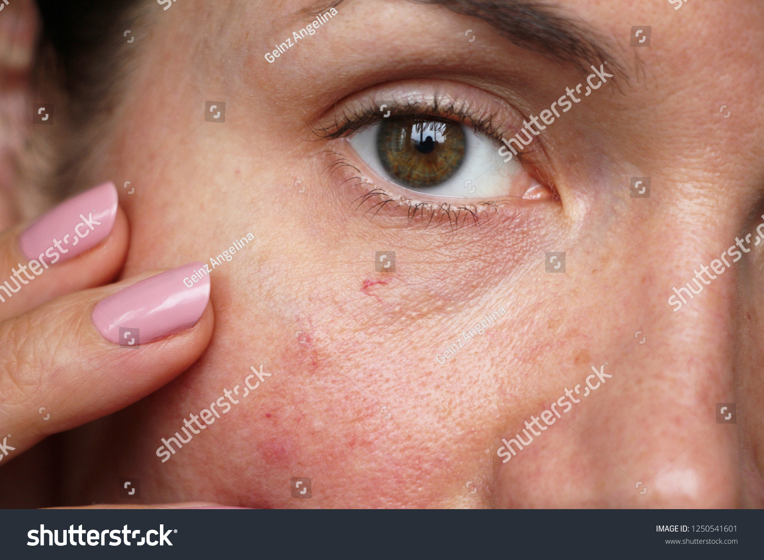 Capillaries On Skin Face Stock Photo 1250541601 | Shutterstock