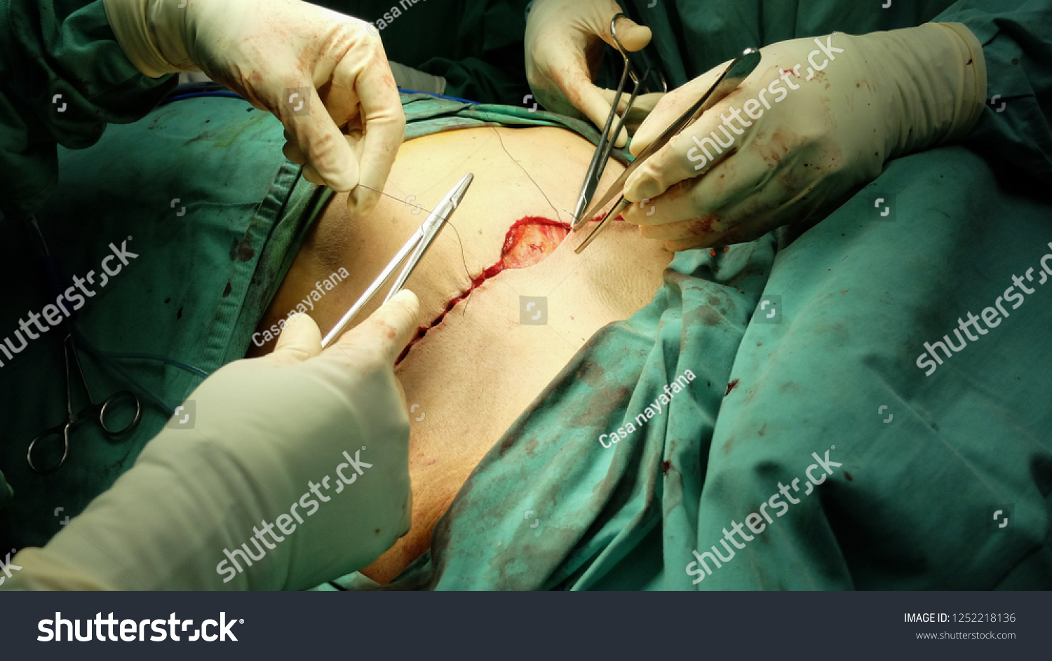 Photo De Stock Closure Mastectomy Skin Incision Subcuticular Method 1252218136 Shutterstock