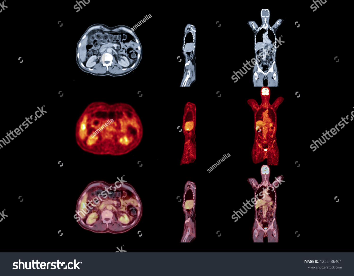 Pet Scan Image Whole Body Comparison Stock Illustration 1252436404 ...