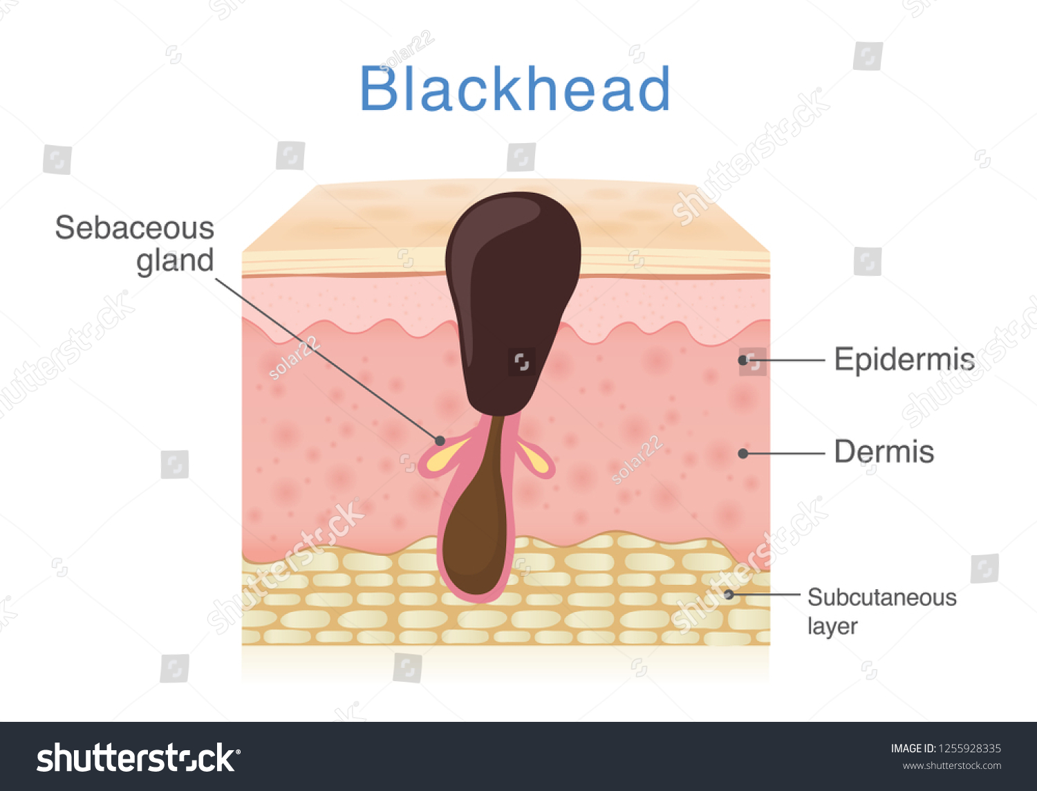 Structure Diagram Skin Blackhead Illustration About Stock Vector