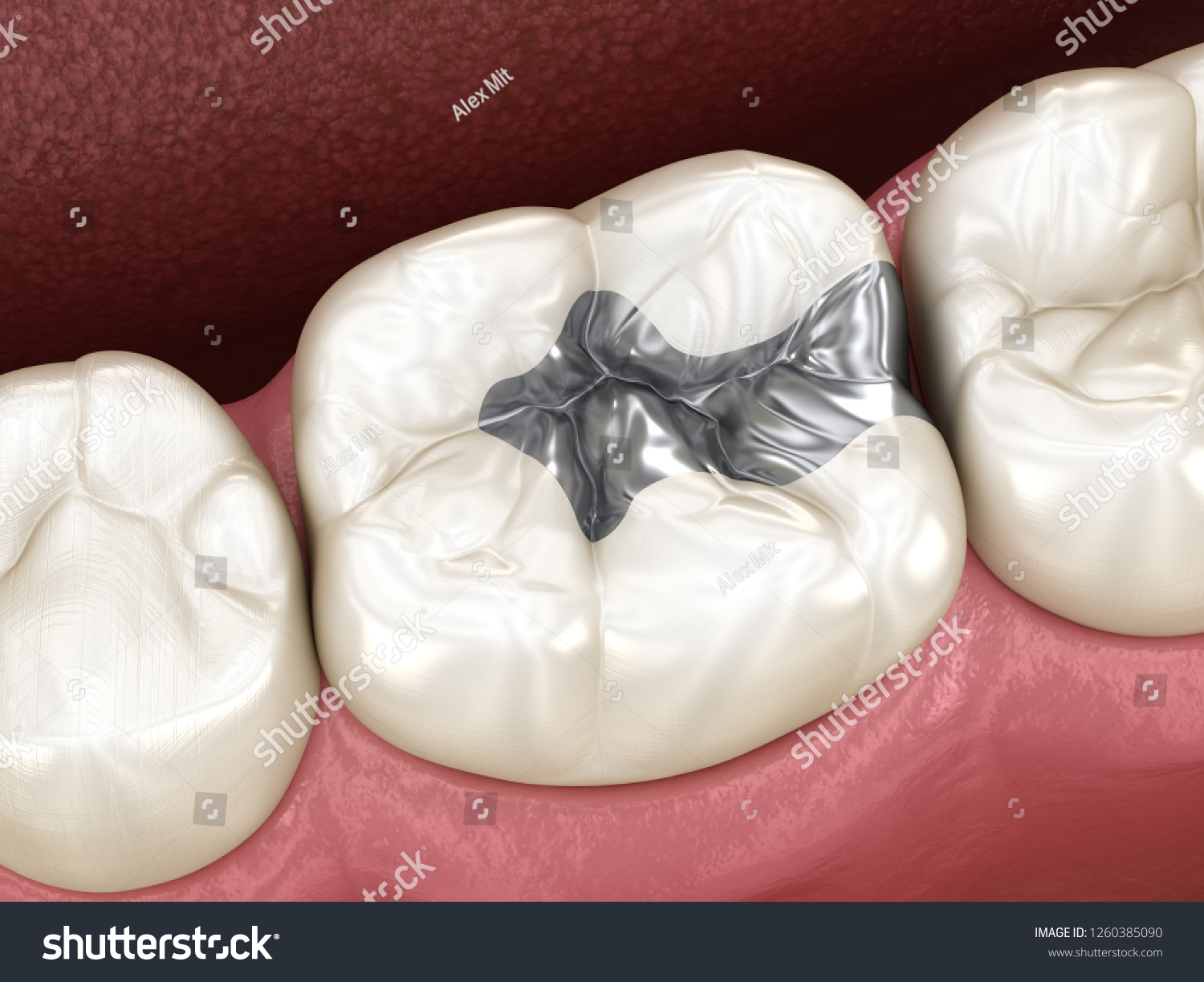 Зубы с медицинского серебра