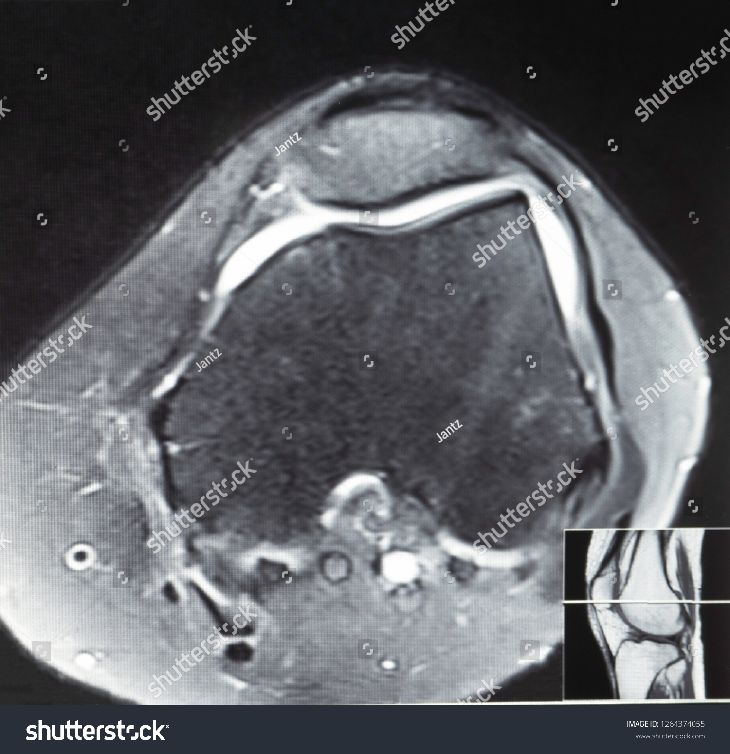 Magnetic Resonance Imaging Mri Image Knee Stock Photo 1264374055 