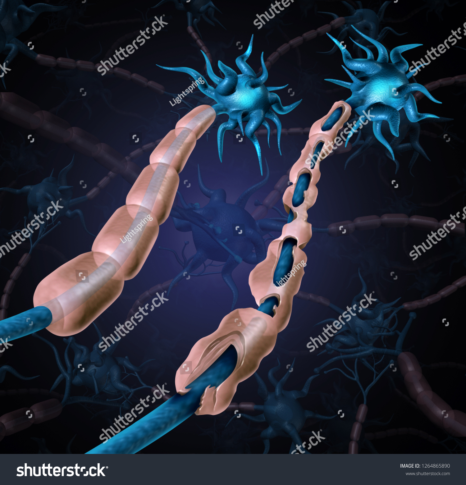 Multiple Sclerosis Damaged Myelin Ms Autoimmune Stock Illustration Multiple Sclerosis Damaged Myelin Ms Autoimmune Stock Illustration