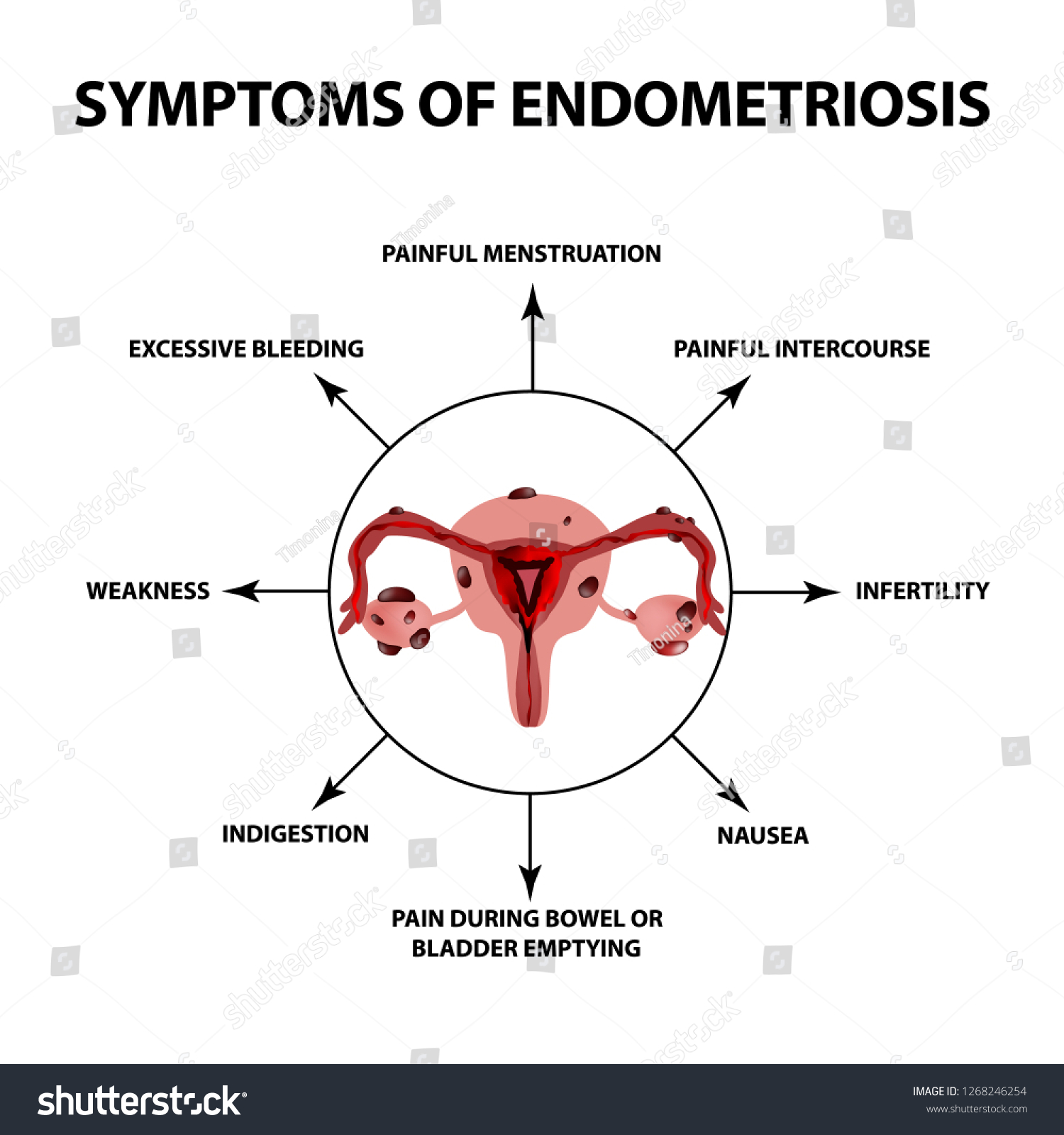 Symptoms Endometriosis Uterus Ovaries Structure Infographics Stock ...